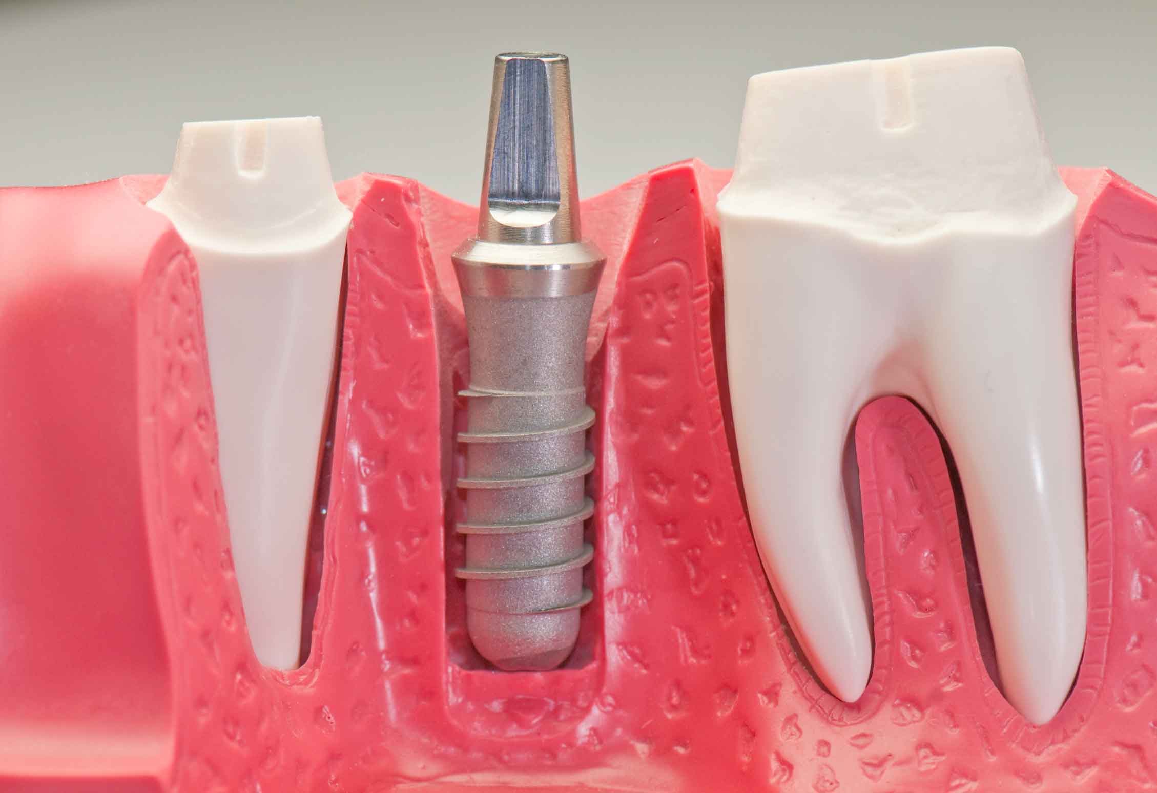 Dental implantlar diş eksikliklerinde, kaybedilen diş ya da dişleri yerine koymak için çene kemiğine yerleştirilen vida formunda yapay köklerdir. İmplant hangi durumlarda yapılır? - İmplant yapımı ağrılı mıdır? - Kimler implant yaptırabilir? - Her diş hekimi implant yapabilir mi? - İmplant tedavisi ne kadar sürer? - İmplant markası önemli midir? - İmplantlar metal dedektöründe öter mi?