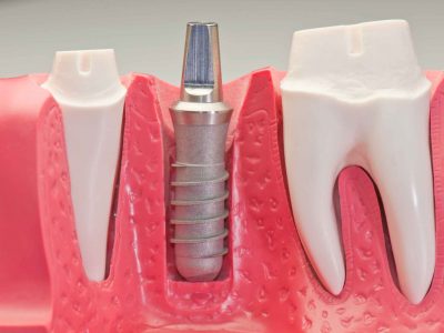 dental implant tedavisi kadikoy istanbul